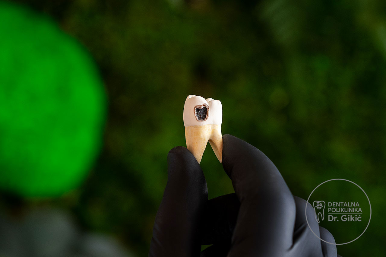 Što podrazumijeva popravak zuba